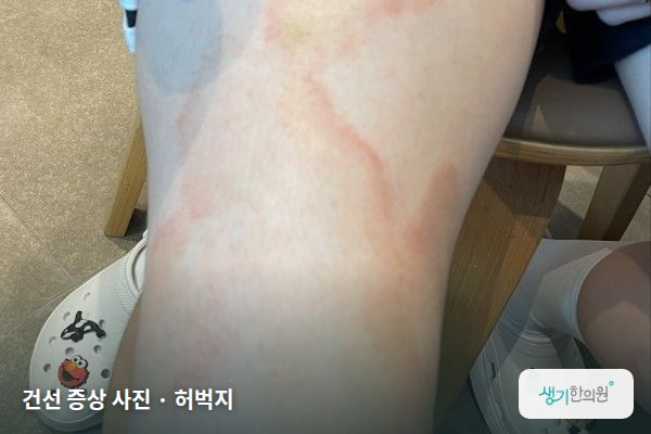 허벅지에 생긴 건선 증상 사진 — 건선 증상 사진 · 허벅지